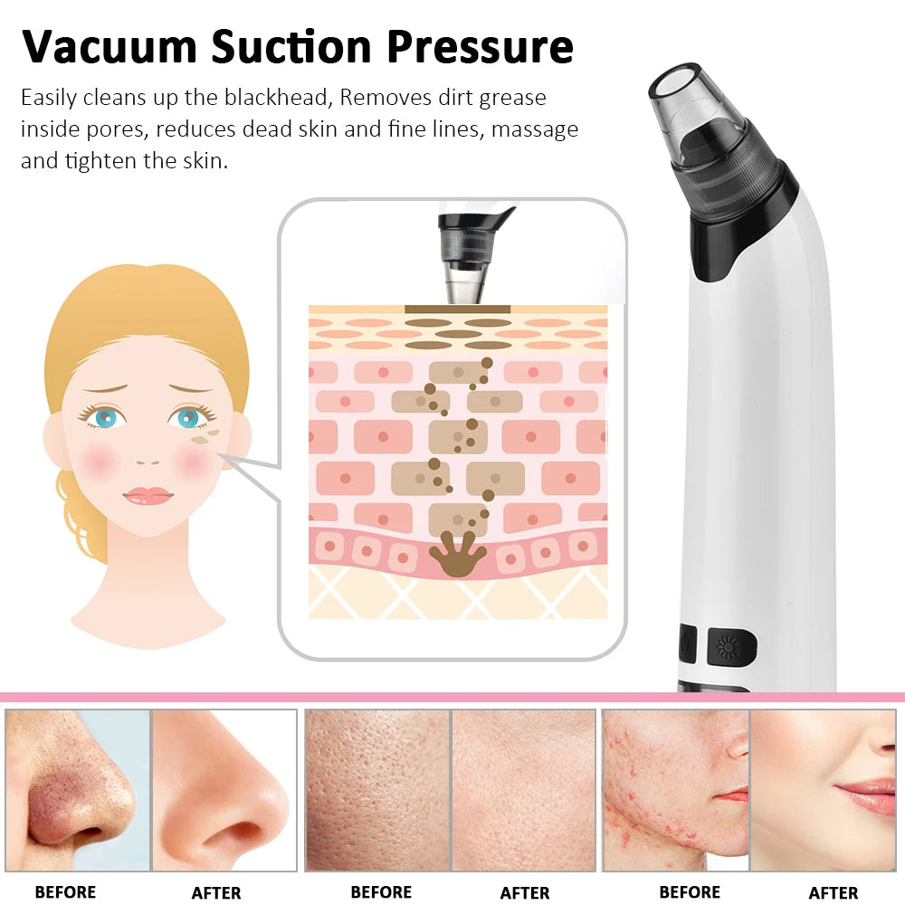Vacuum Blackhead Remover Cleaner